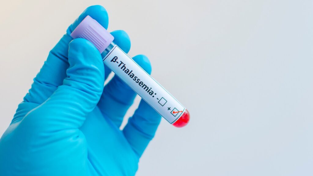Guarire dalla talassemia beta con la terapia genica