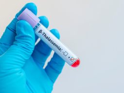 Guarire dalla talassemia beta con la terapia genica